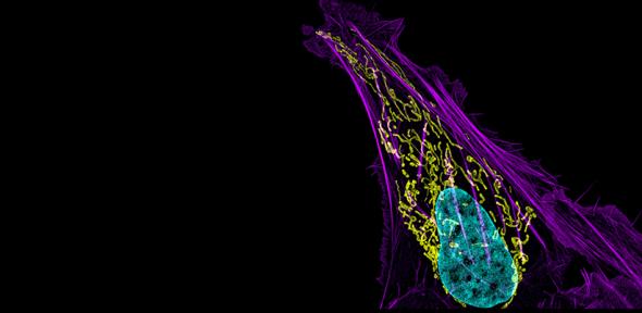 Bone cancer cell (nucleus in light blue)