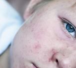 Very sick 5 year old little boy fighting measles infection, boy is laying in bed under the blanket with an agonizing expression, boy is covered with rash caused by virus.