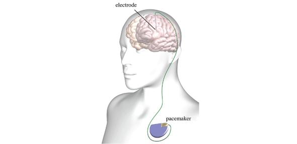 Graphic demonstrating deep brain stimulation